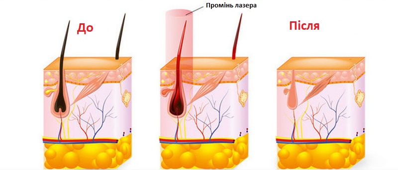 Епіляція бікіні