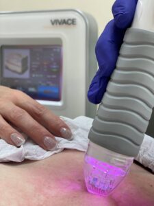 Microneedle RF lifting in Lviv